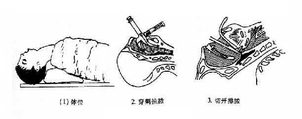 �ڰ˽ڡ��ʺ�ŧ�ף�retropharyngeal abscess��
