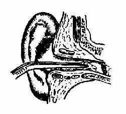 ��һ�ڡ���������foreign body in external auditory meatus��