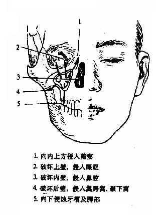 ��һ�ڡ����񼰩��carcinoma of the maxillary sinus��