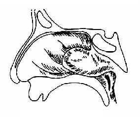 ڡѪάangiofibroma of naspharynx