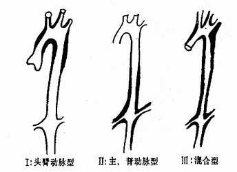 ���Ľڡ��෢�Դ����ף�Multiple Arteritis)