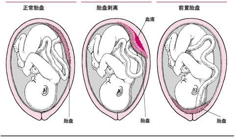 第245节 妊娠并发症
